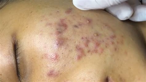 Cyst removal videos are not as easy to watch as pimple or blackhead popping videos, we know that. . Infected cystic acne removal videos 2022